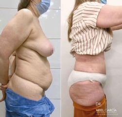 Liposucción - Dr. Ariel Ignacio García
