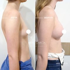 Aumento mamas  - Dr. Ariel Ignacio García