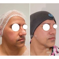 Rinoplastia - Dr. Ariel Ignacio García