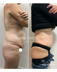 Abdominoplastia - Dr. Ariel Ignacio García