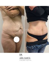 Abdominoplastia - Dr. Ariel Ignacio García