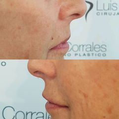 Relleno de labios - Dr Luis Corrales