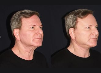 Lifting - Dr. Williams Erik Bukret