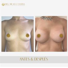 Aumento mamas - Dra. Micaela Taverna