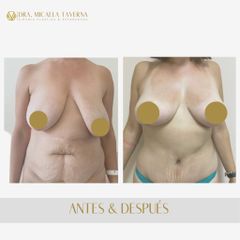 Lipoescultura - Dra. Micaela Taverna