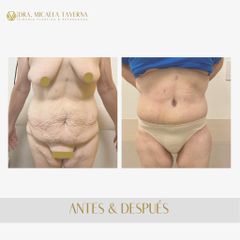 Abdominoplastia - Dra. Micaela Taverna