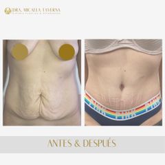 Abdominoplastia - Dra. Micaela Taverna
