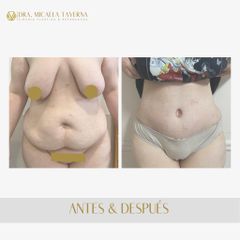 Abdominoplastia - Dra. Micaela Taverna