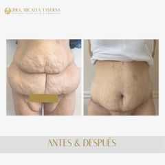 Abdominoplastia - Dra. Micaela Taverna