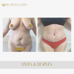 Abdominoplastia - Dra. Micaela Taverna