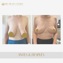 Reducción mamas - Dra. Micaela Taverna