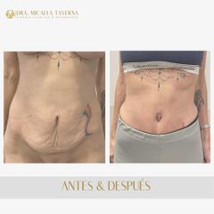 Abdominoplastia - Dra. Micaela Taverna