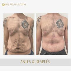 Abdominoplastia - Dra. Micaela Taverna