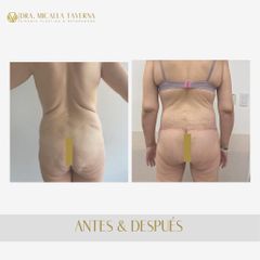 Liposucción - Dra. Micaela Taverna