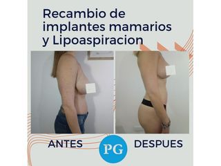 Recambio de Implantes Mamarios - Dra. Paula Granero