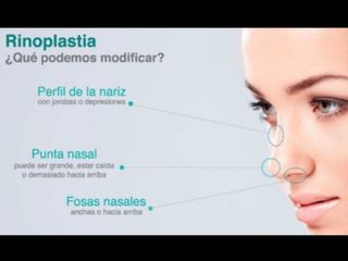 Rinoplastia