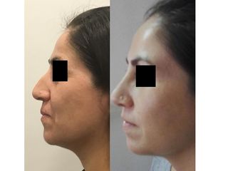 Rinoplastia