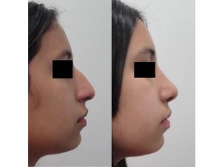 Rinoplastia