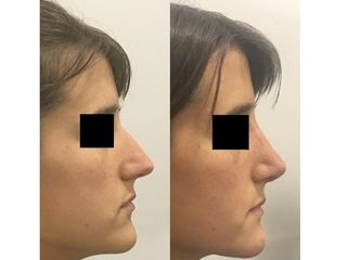 Rinoplastia