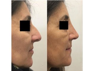 Rinoplastia