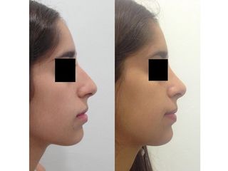 Rinoplastia