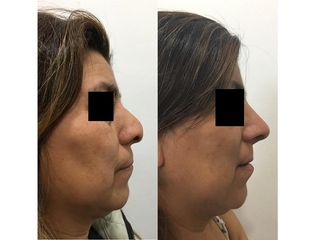 Rinoplastia