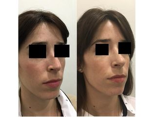 Rinoplastia