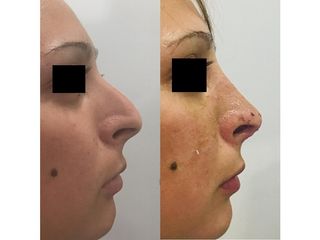 Rinoplastia