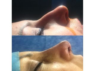 Rinoplastia 