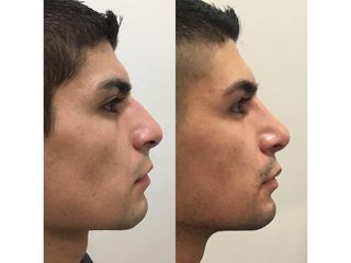 Rinoplastia - Dr. Ignacio Amado