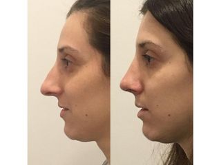 Rinoplastia - Dr. Ignacio Amado