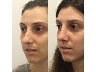 Rinoplastia - Dr. Ignacio Amado