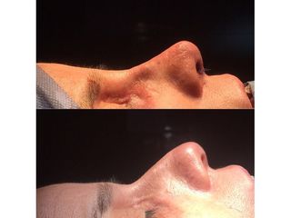 Rinoplastia - Dr. Ignacio Amado