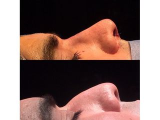 Rinoplastia - Dr. Ignacio Amado