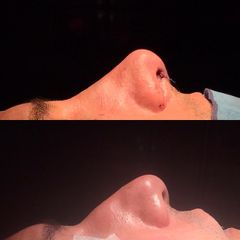 Rinoplastia - Dr. Ignacio Amado