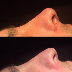 Rinoplastia - Dr. Ignacio Amado