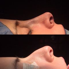 Rinoplastia - Dr. Ignacio Amado