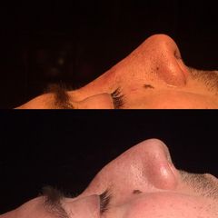Rinoplastia - Dr. Ignacio Amado