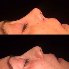 Rinoplastia - Dr. Ignacio Amado