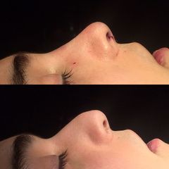 Rinoplastia - Dr. Ignacio Amado