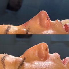 Rinoplastia - Dr. Ignacio Amado