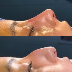 Rinoplastia - Dr. Ignacio Amado