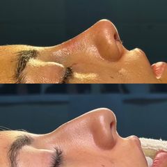 Rinoplastia - Dr. Ignacio Amado