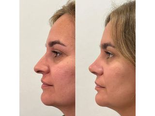 Rinoplastia - Dr. Ignacio Amado