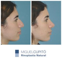 Rinoplastia - Dr. Miguel Ángel Cupito