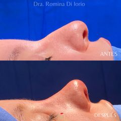 Rinoplastia - Di Iorio - Cajelli