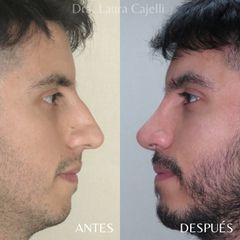 Rinoplastia - Di Iorio - Cajelli