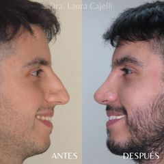 Rinoplastia - Di Iorio - Cajelli