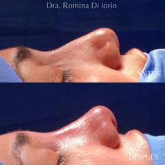 Rinoplastia - Di Iorio - Cajelli