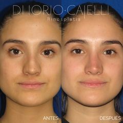 Rinoplastia - Di Iorio - Cajelli